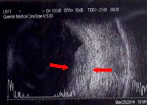 B Scan Ultrasonography Finding B Scan Sonogram Shows Increased