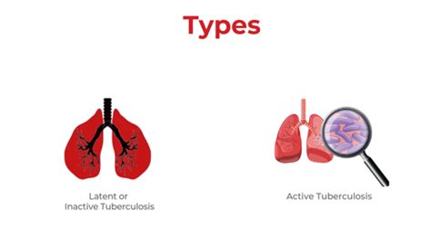 All About Tuberculosis Types Symptoms Diagnosis And More Dr Lal