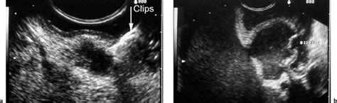 Endoscopic Ultrasound In Subepithelial Tumors Of The Gastrointestinal Tract Radiology Key