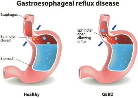 Gerd Acid Reflux Symptoms Causes Treatment Diet And More