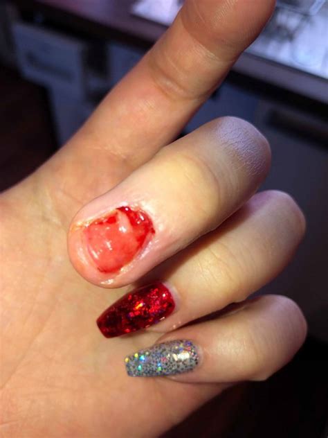 Womans Nail Ripped Off After Manicure With Super Strong Acrylic Glue