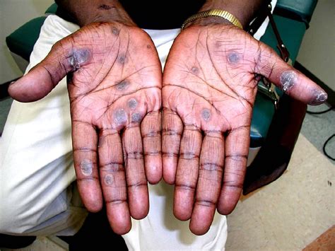 Syphilitic Lesions On The Hands Download Scientific Diagram