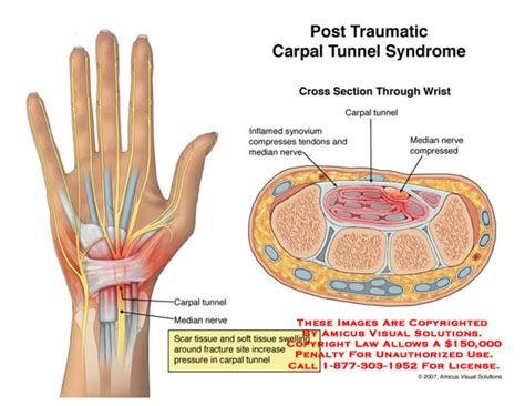 Amicus Illustration Of Amicus Injury Carpal Tunnel Syndrome Post Traumatic Posttraumatic
