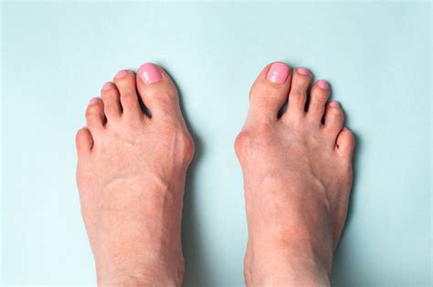 Wann kann ich nach hallux valgus op wieder wandern? Hallux Valgus : Quels Sont les Traitements Offerts Pour Le ...