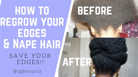 How To Regrow Your Edges And Nape Hair Igbocurls