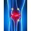 FDA Clears Radiofrequency Treatment For Osteoarthritis Knee Pain 