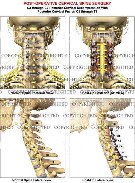 4 Level C3 C7 Post Op Cervical Spine Decompression — Medical Art Works
