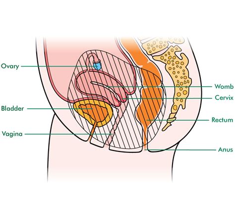What Is Pelvic Exenteration In Women Information And Support