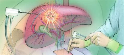 Liver Tumor Ablation — The Interventional Initiative