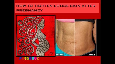 How To Tighten Loose Skin After Pregnancy Youtube
