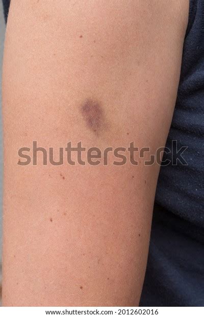 Hematoma Bruise On Woman Arm Pain Stock Photo 2012602016 Shutterstock