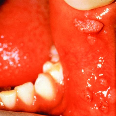 Eruption Hematoma Often Associated With An Erupting Primary Tooth