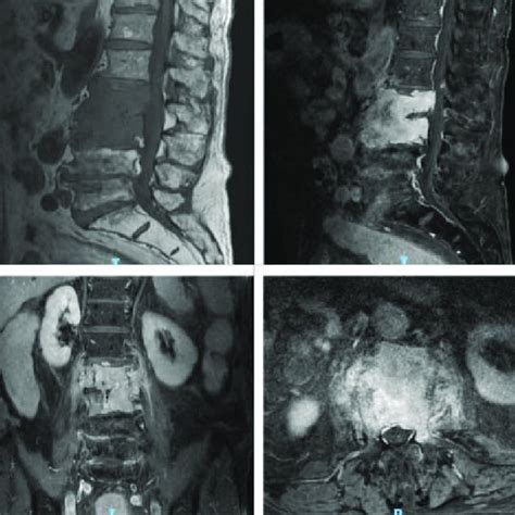 Mri Scan Of The Lumbar Spine Performed At A Different Hospital When The