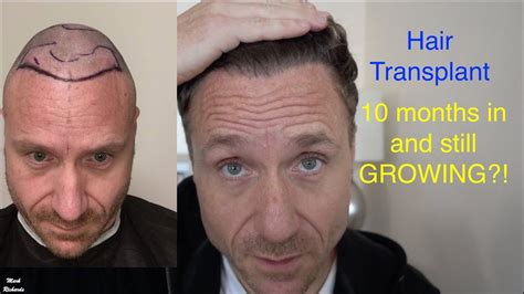It Still Keeps GROWING Month 10 Hair Transplant In TURKEY YouTube