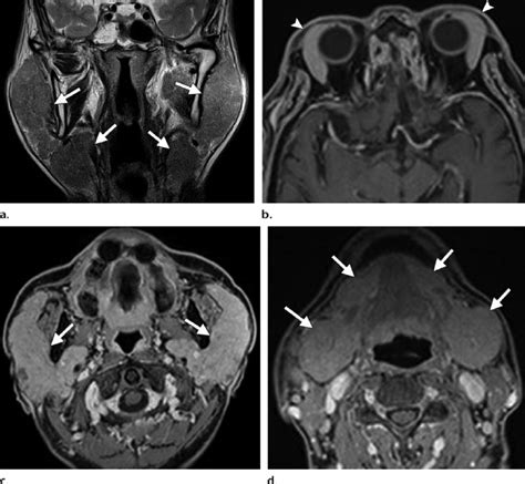 Mikulicz Disease In A 67 Year Old Man A Coronal T2 Weighted Mr Image