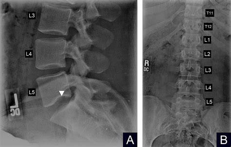 Cureus A Case Of Persistent Low Back Pain In A Young Female Caused By