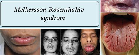 Melkersson Rosenthalův Syndrom Příznaky Projevy Symptomy Příčina