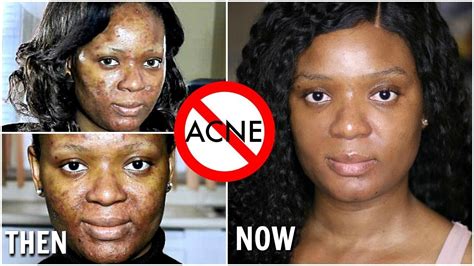 Not Sponsored How I Finally Cleared My Acne And Scars Dermatologist