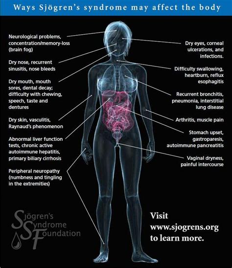 1000 Images About Sjogrens Syndrome On Pinterest Mouths The