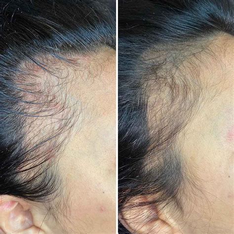 Derma Roller Hair Regrowth Everything You Need To Know