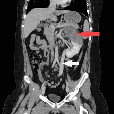 A coronal plane (also known as the frontal plane) is any vertical plane that divides the body into ventral and dorsal (belly and back) sections. Figure 1 - Disseminated Echinococcus multilocularis ...