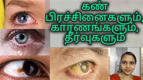 Eye Problems Symptoms Solutions Children And Adults