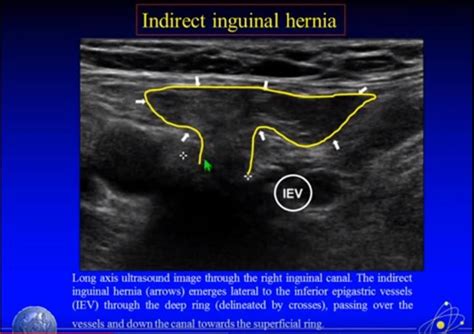 Ultrasound Imaging Of Hernia Parts 1 2 Of 4 A Youtube