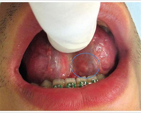 Scielo Brasil Lymphoepithelial Cyst On The Tongue Case Report At