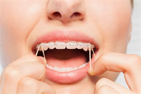 The Importance Of Orthodontic Elastics Dunegan Cole Orthodontics Gainesville Virginia