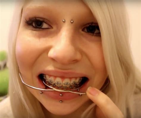 Braces Braceface Metalbraces Girlswithbraces Headgear Zahnspange Zähne Schönheit