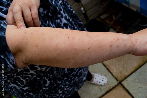 Bed Bug Bites Swelling And Scars In Multiple Locations On The Skin Of