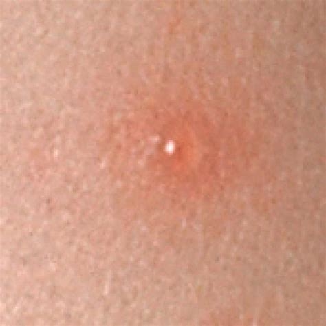 What May Be Causing Those Itchy Bumps Filled With Clear Liquid Skin