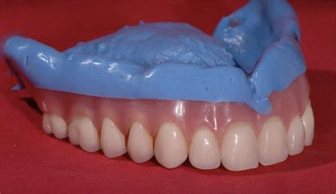 Dental Labs For Dentures In Arizona Conventional Full And Partial