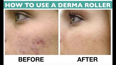 Derma Roller Before And After Photos MGP Animation