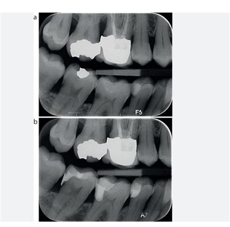 Dental Radiography Flashcards Quizlet