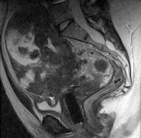 Black Spots On Ct Scan Of Abdomen And Pelvis Captions More