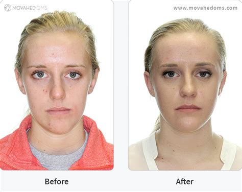 Tmj Surgery Before And After Photos