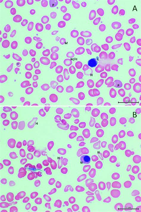 Peripheral Blood Smear X100 Of Case 1 A Photomicrograph Showing
