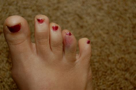 Experiencing big toe pain can also cause pain when walking, swelling in the toe, or discoloration of the big toe. Broken Toe | shar A hope