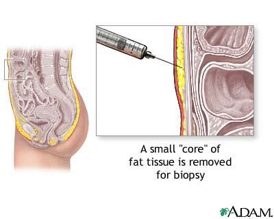Fat Tissue Biopsy MedlinePlus Medical Encyclopedia Image