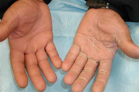 An Itchy Rash On A Mans Hand Clinical Advisor