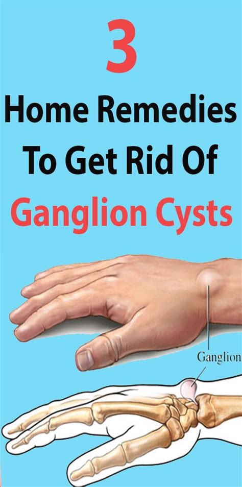 How Do You Get Rid Of A Ganglion Cyst On Your Foot Chris Mehl Kapsels