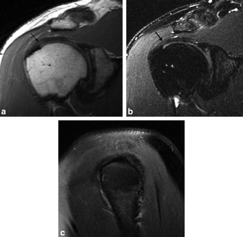 Coracoid process fracture. Oblique sagittal fat saturated ...