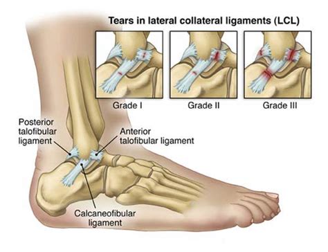 Ankle Ligament Surgery And Recovery Timeline New Health Advisor