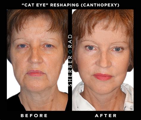 35% off your first repeat delivery. Cat Eye Reshaping Washington DC | Canthopexy Northern VA