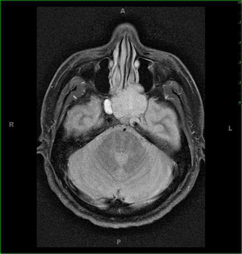 Adenoid Cystic Carcinoma Sphenoid Sinus Neuro Mr Case Studies