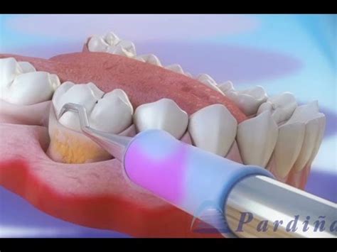 Periodontal Treatment Gum Treatment Dentistry Clinic