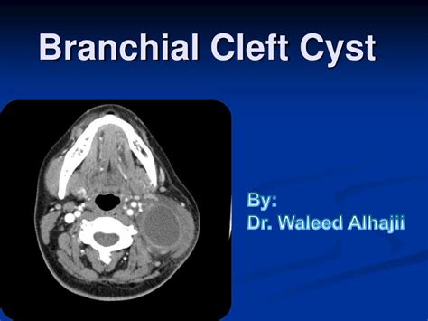 Ppt Branchial Cleft Cyst Powerpoint Presentation Id261469