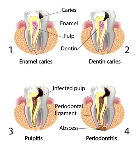 Stages Of Caries Development By Century City Dentist Welcome To Dr Arman Torbati S Dental