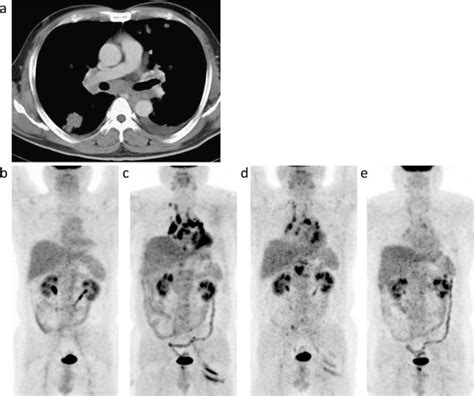 Case 1 A Contrast Enhanced Ct Image Taken At The Time Of The Diagnosis